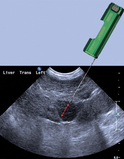 CT & Ultrasound Guided Biopsies